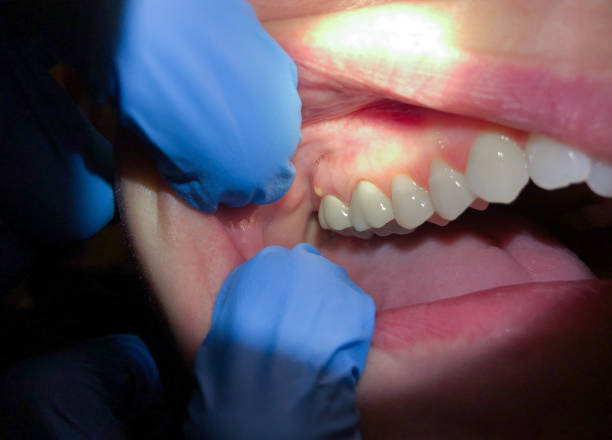 Best Dental Abscess Treatment in Temple, TX